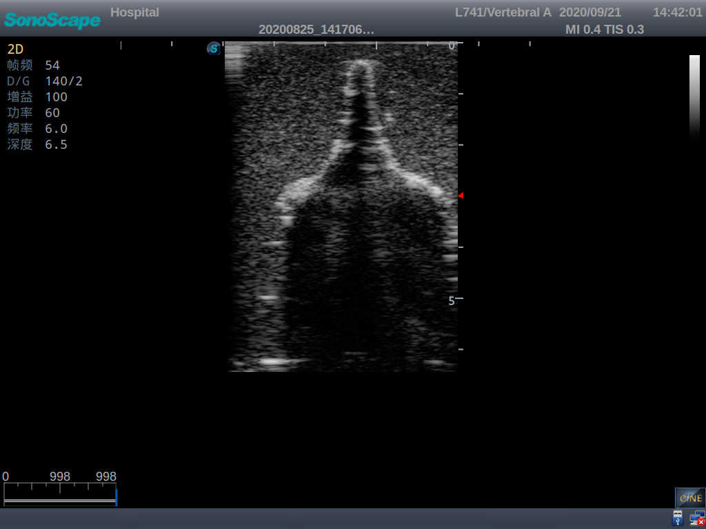 Pediatric Lumbar Puncture Ultrasound Training Model