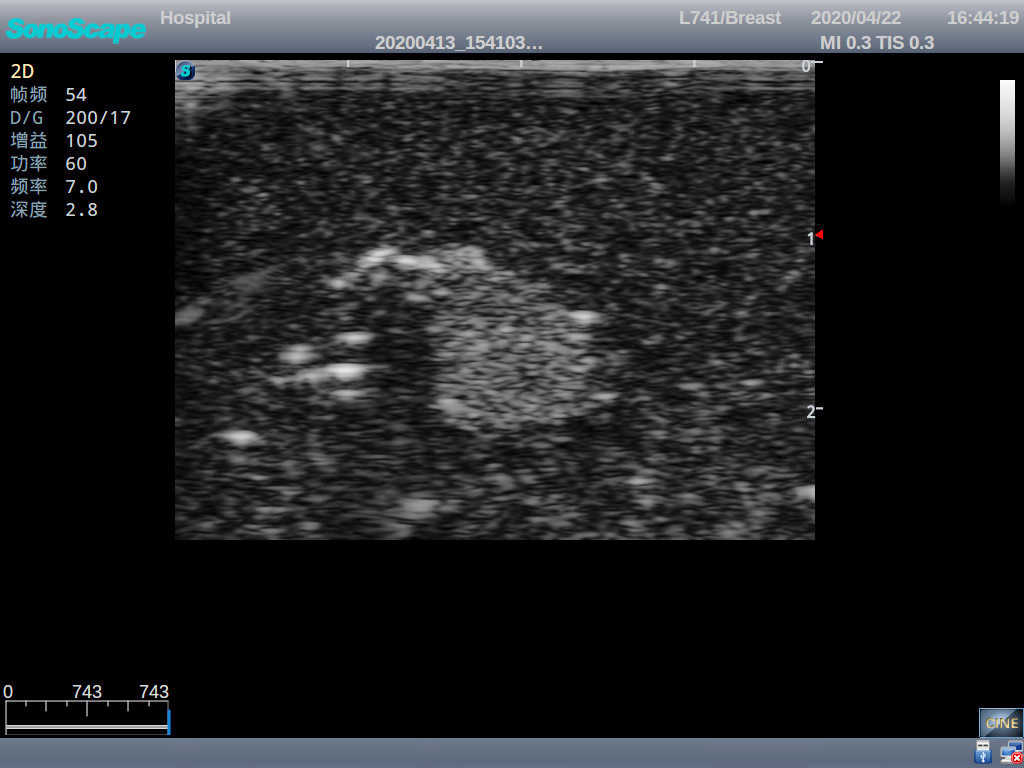 Breast Ultrasound Examination Model